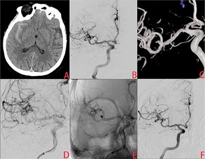 Endovascular Treatment of Ruptured Very Small Intracranial Aneurysms: Complications, Recurrence Rate, and Clinical Outcomes